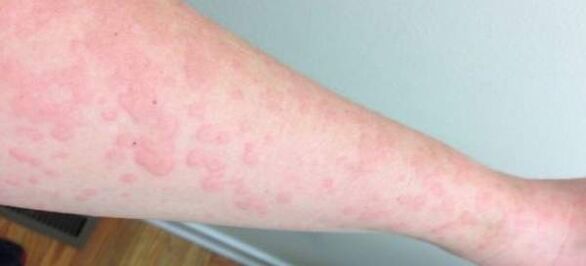 Kožné alergie sú známkou prítomnosti parazitov v tele